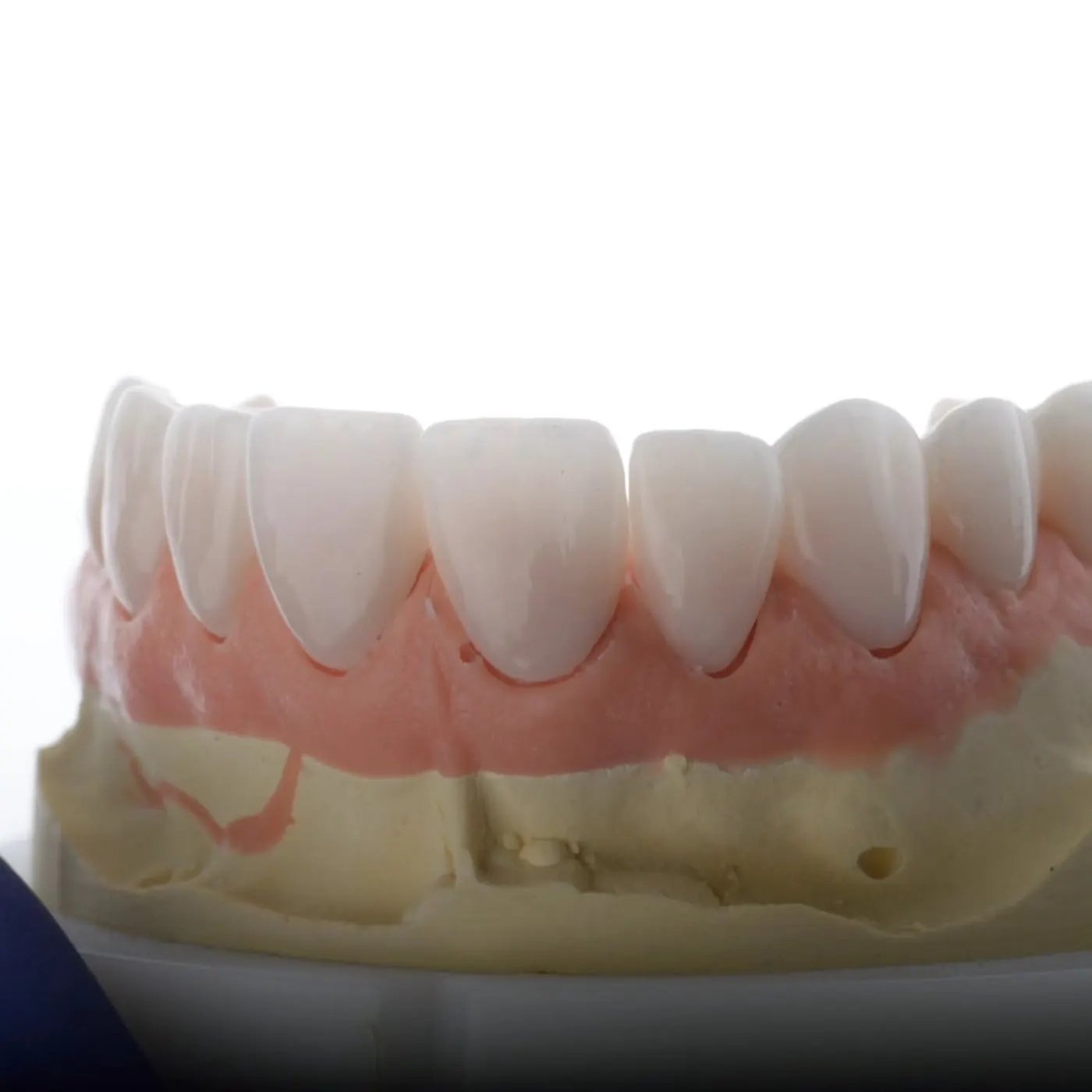 A new dental bridge on its working model