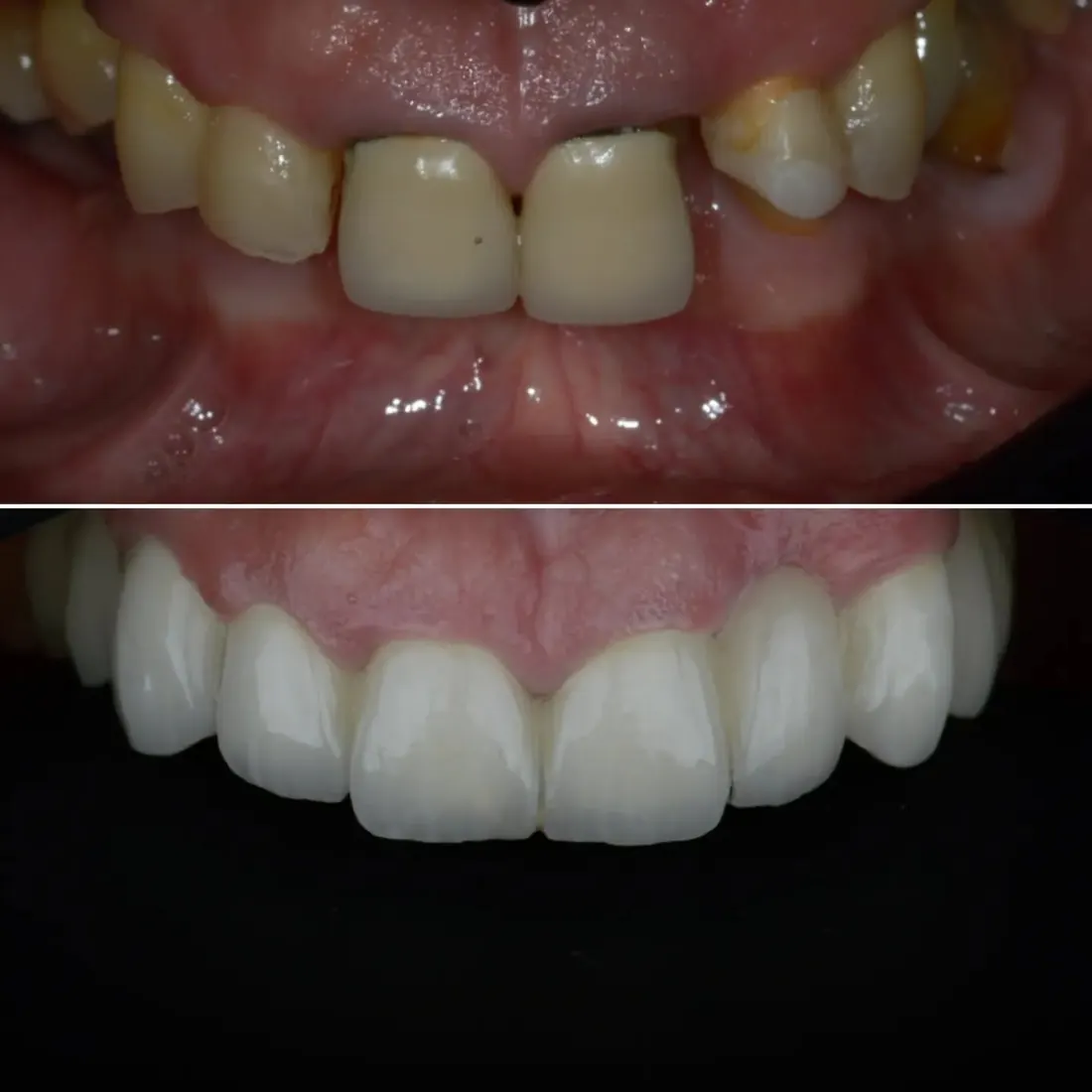 Before and after: front teeth restored by Dr. Sremčević