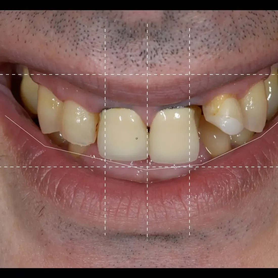 Before and after: a smile planned and restored by Dr. Sremčević