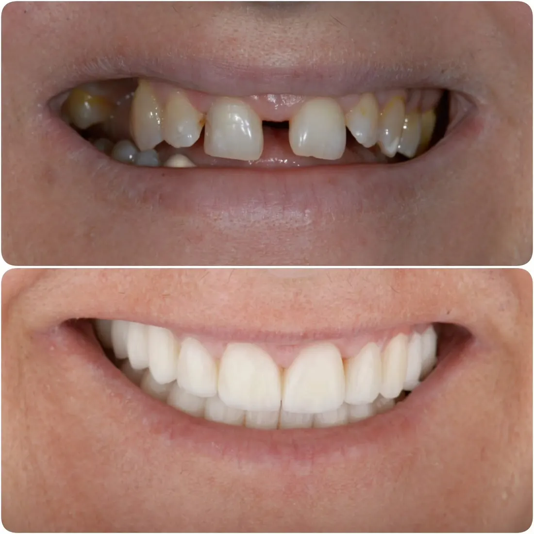 Before and after: a gap in the front teeth closed by Dr. Sremčević