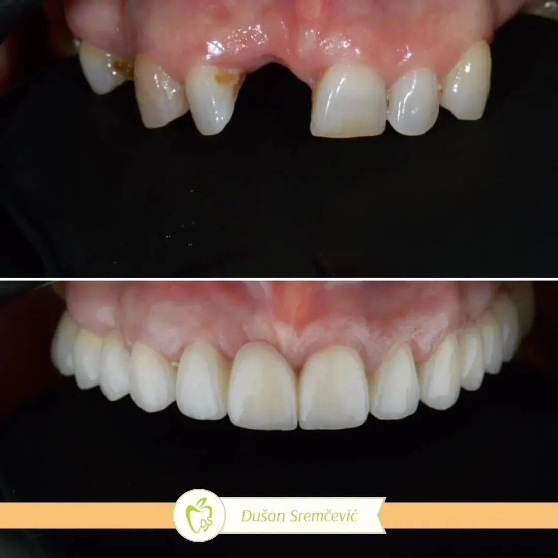 Before and after: a missing front tooth replaced by Dr. Sremčević