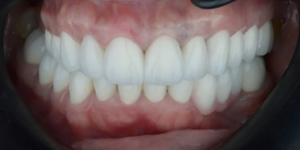 After: aging crowns replaced with new ceramic crowns
