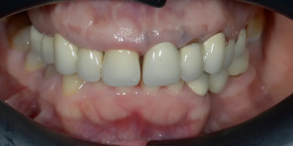 Before: aging crowns replaced with new ceramic crowns