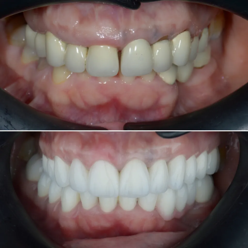 Before and after: aging crowns replaced with new ceramic restorations