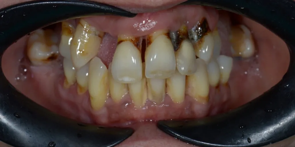 Before: a whole bite rebuilt after gum disease
