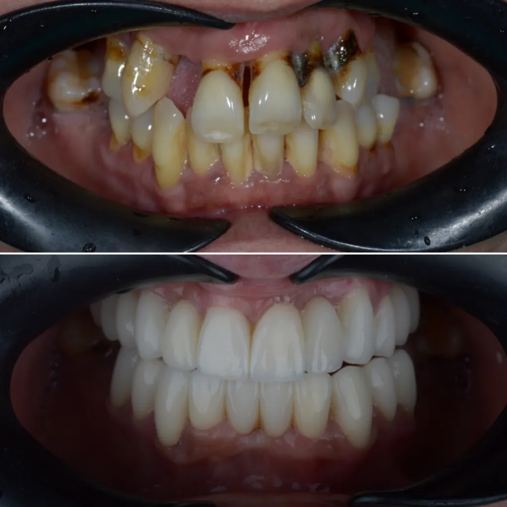 Before and after: full functional and esthetic rehabilitation following gum disease