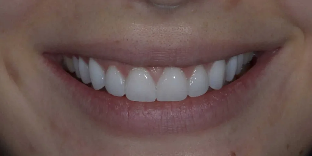 After: a smile restored by Dr. Sremčević