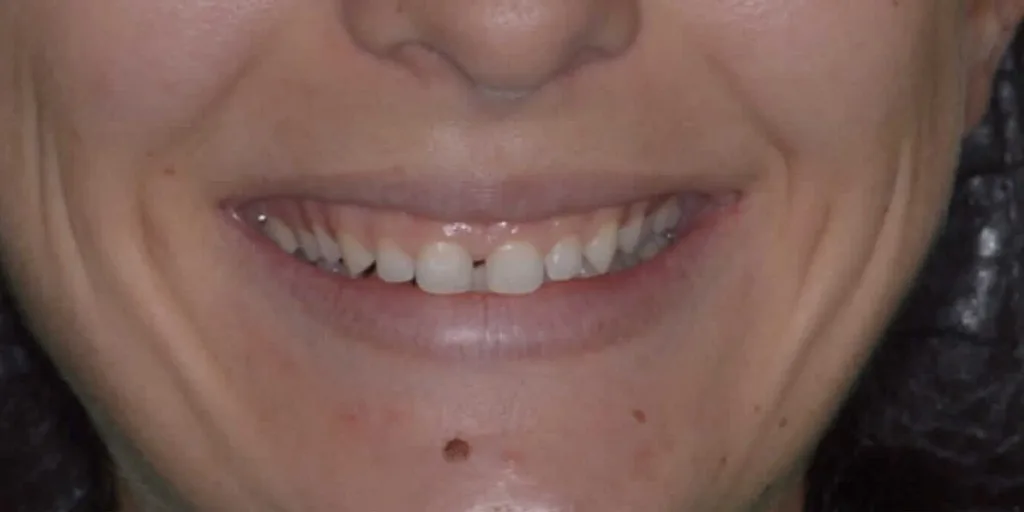 Before: a smile restored by Dr. Sremčević