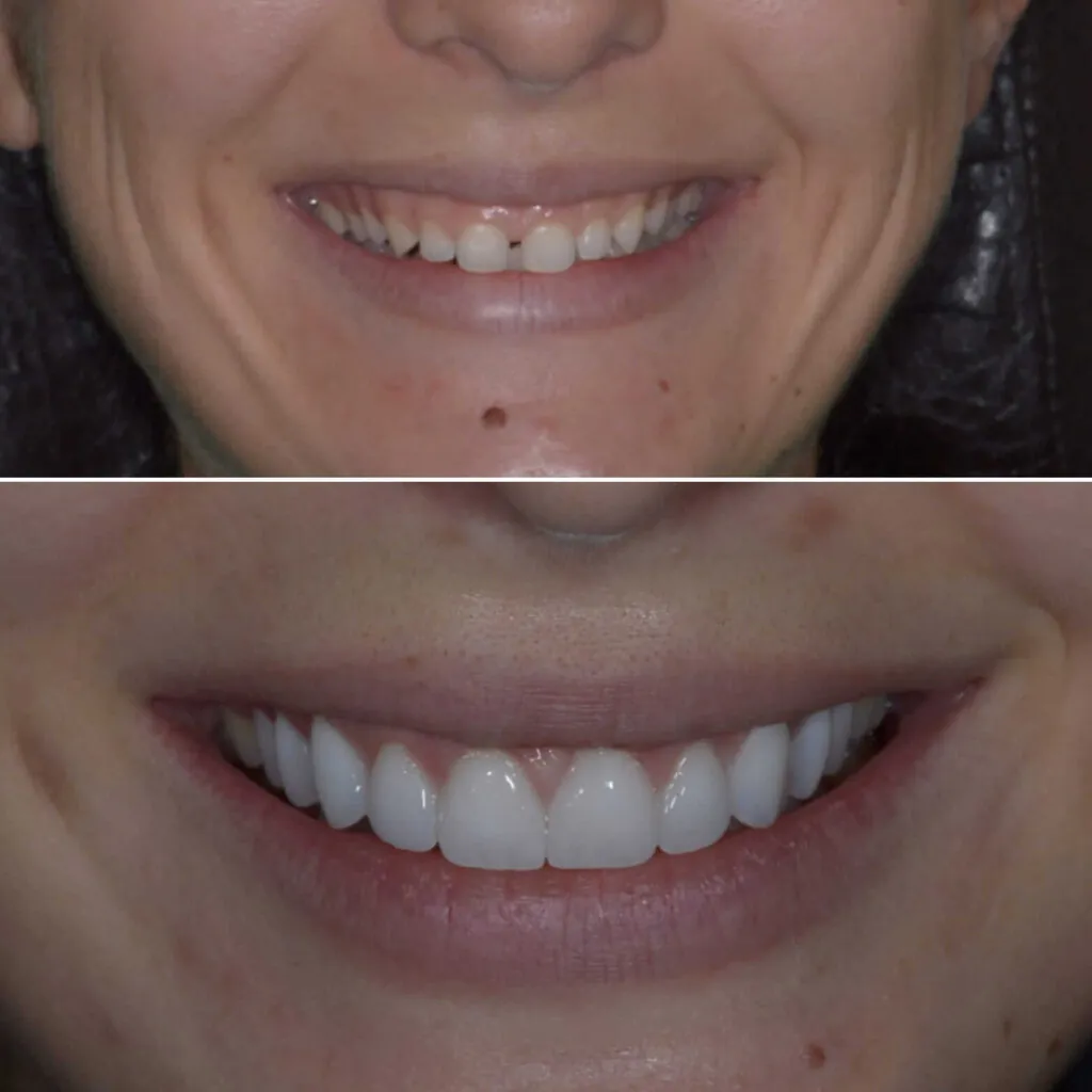 Before and after: a smile restored to a natural, even brightness