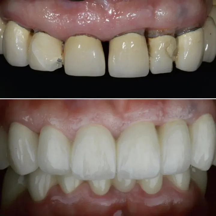 Before and after: front teeth restored by Dr. Sremčević