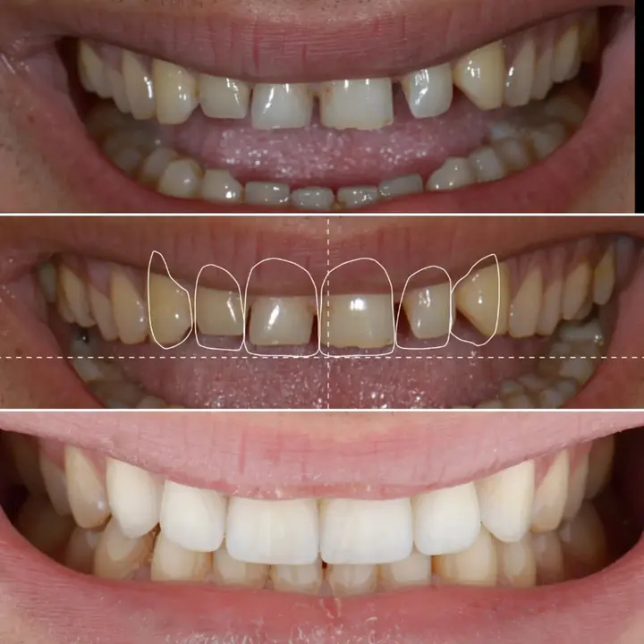 Before and after: a smile planned and restored by Dr. Sremčević, with the planned outline shown in the middle