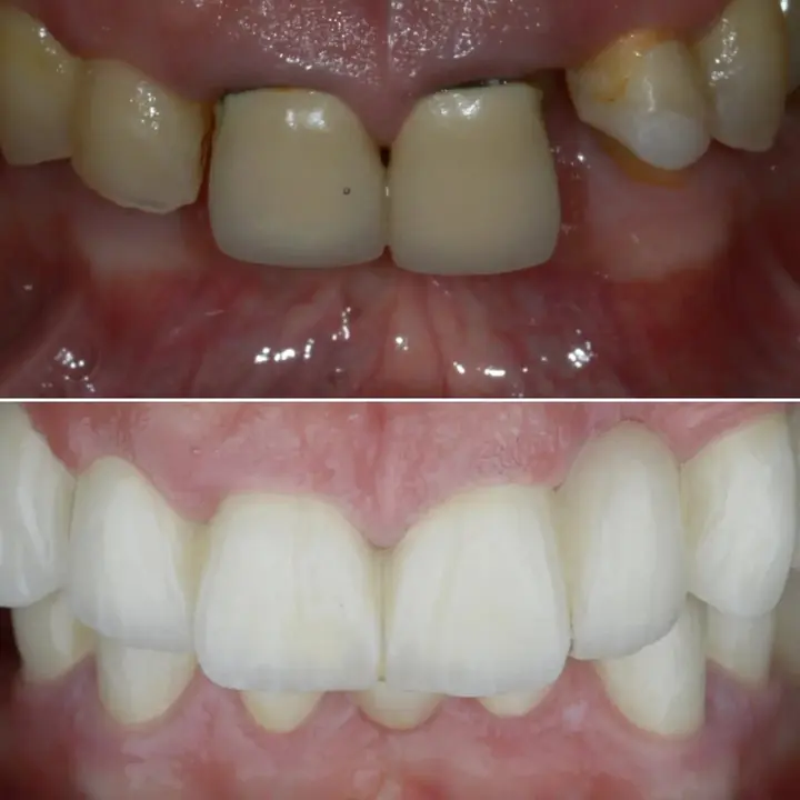 Before and after: front teeth restored by Dr. Sremčević, before above, after below