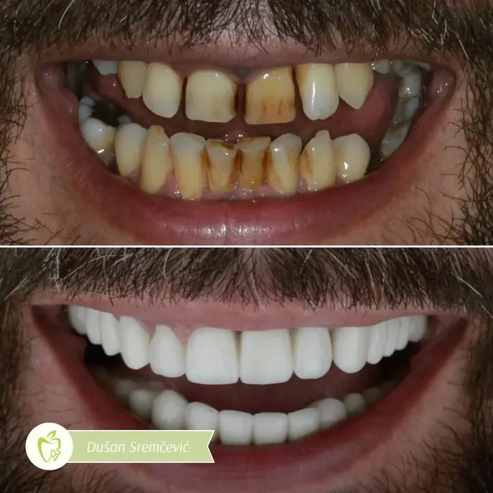 Before and after: a full smile restored by Dr. Sremčević, before above, after below