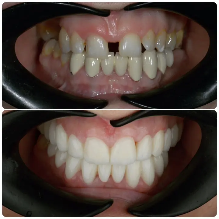 Before and after: a patient’s smile treated by Dr. Sremčević, before above, after below