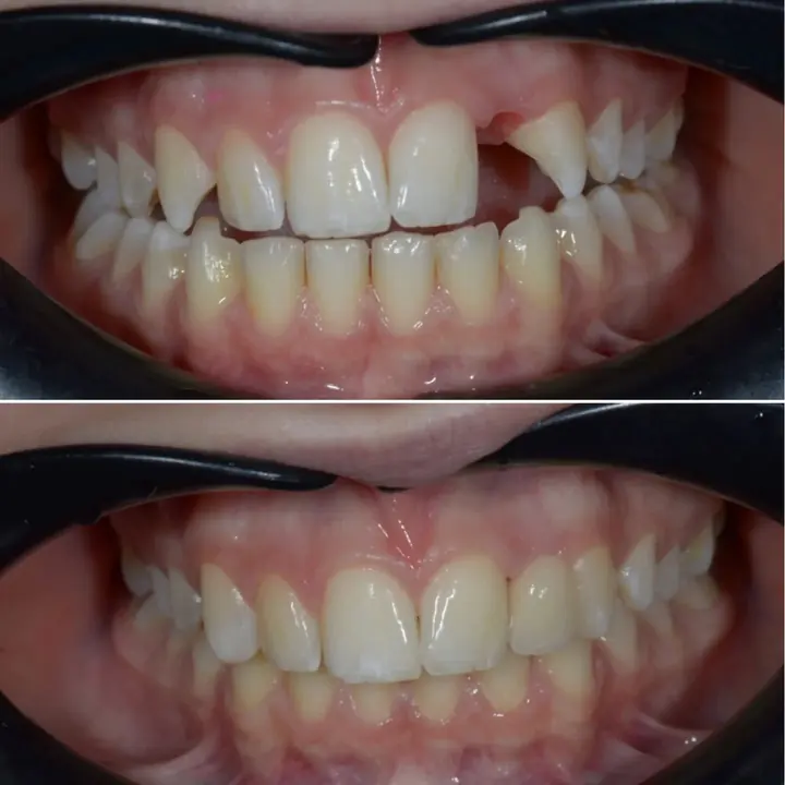 Before and after: missing and uneven front teeth restored by Dr. Sremčević